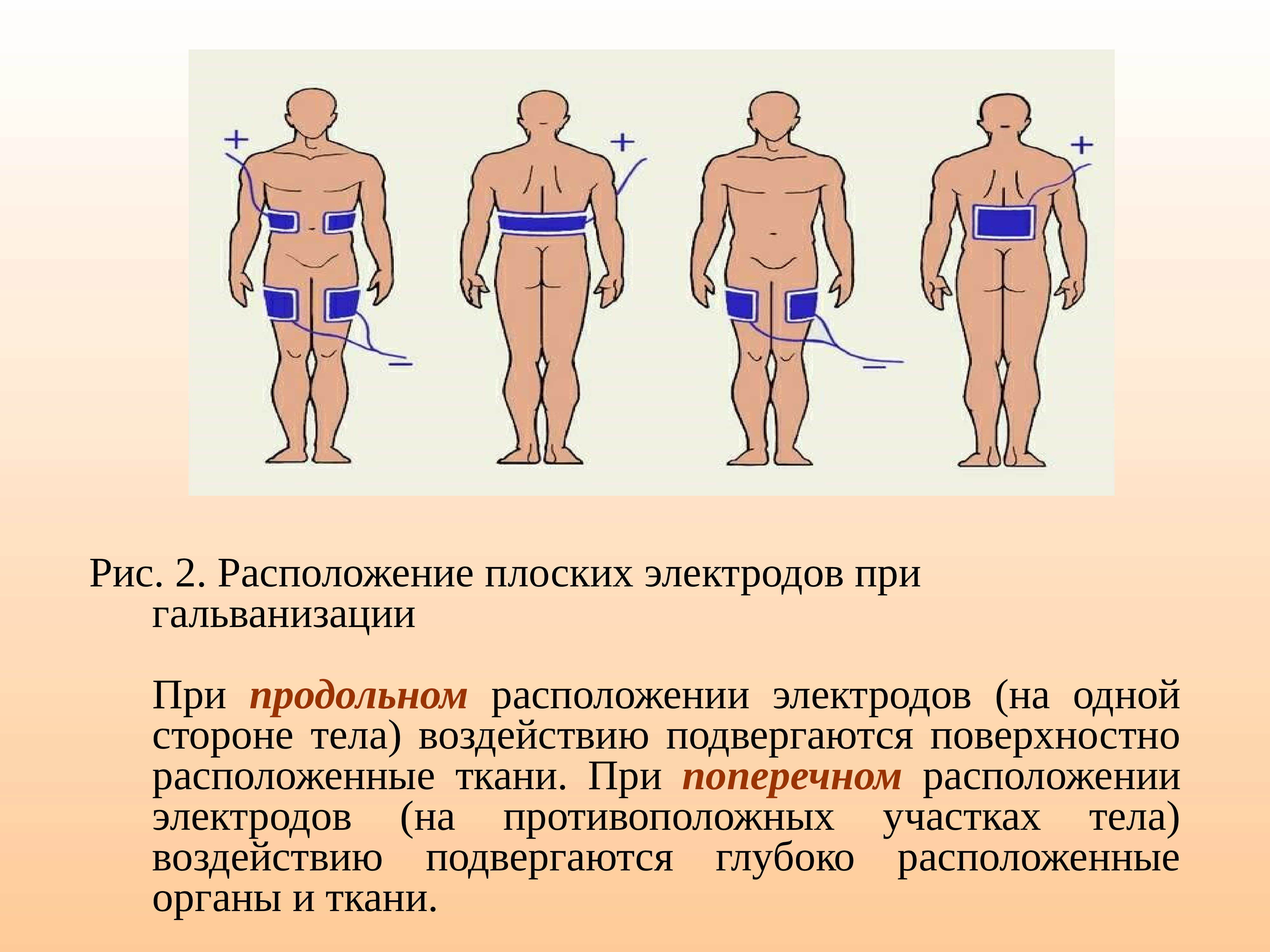 Продольное расположение. Продольное наложение электродов. Методика наложения электродов при гальванизации. Электрофорез поперечное расположение электродов. Продольная методика наложения электродов.