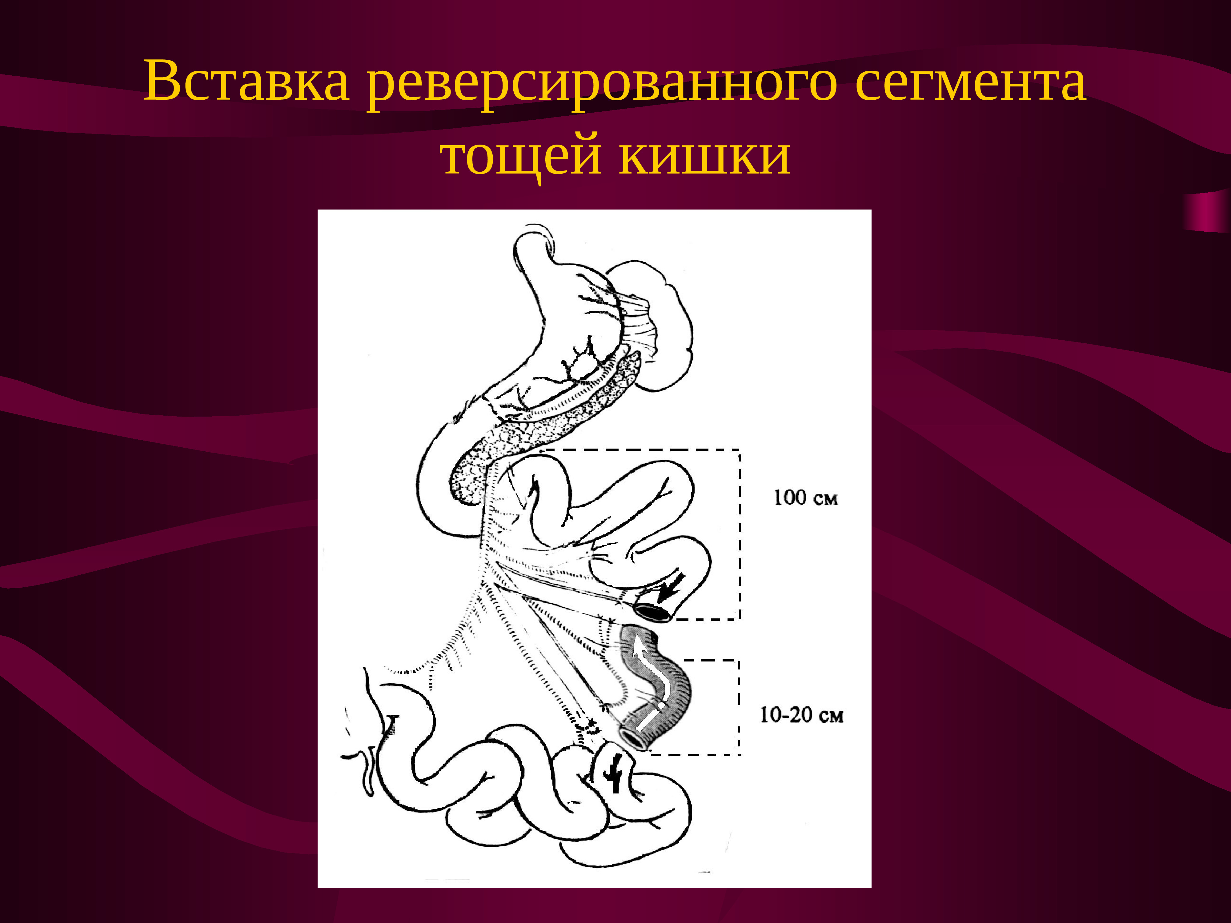 Презентация болезнь оперированного желудка