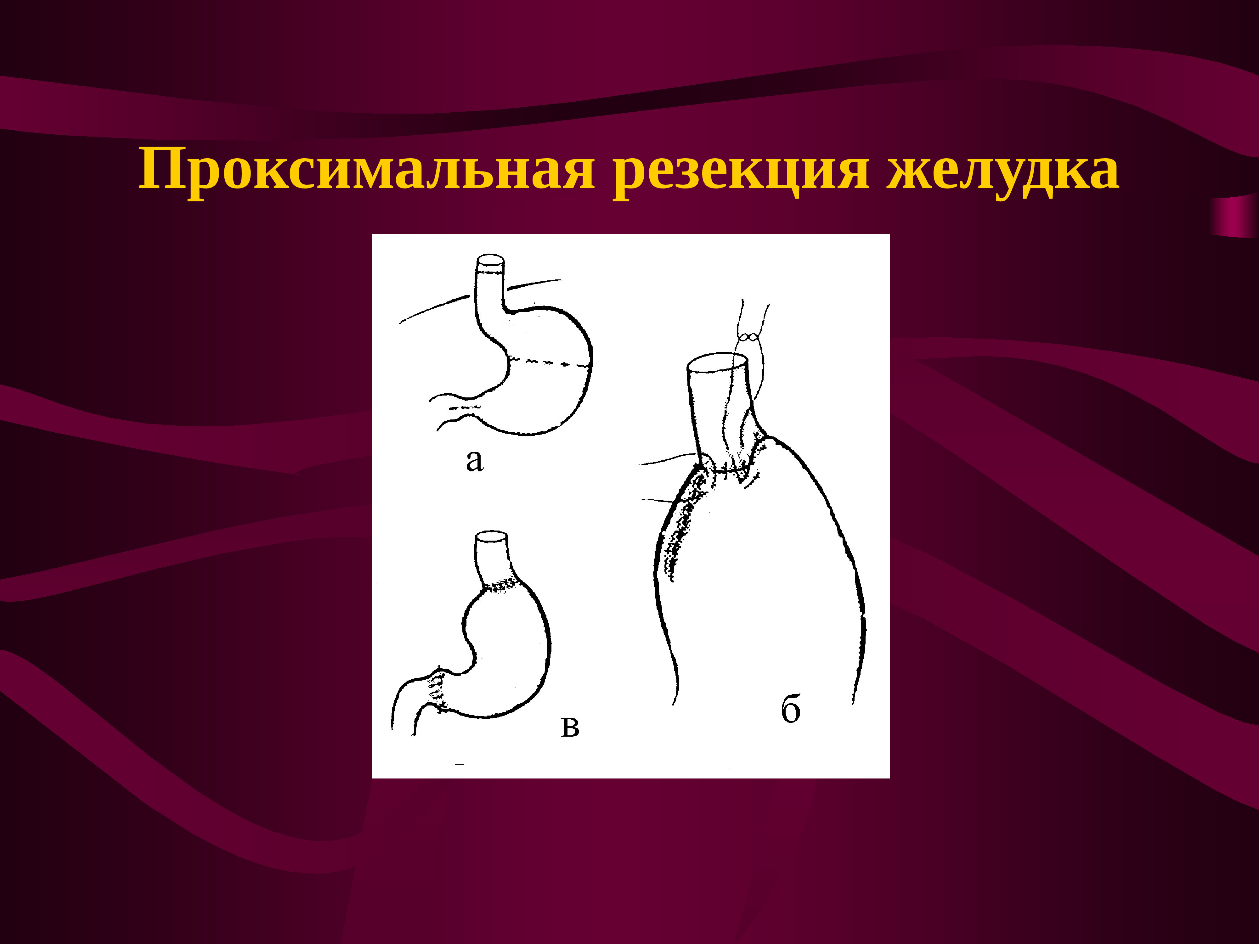 Резекция желудка. Проксимальная субтотальная резекция. Проксимальная резекция желудка. Радикальная субтотальная резекция желудка. Дистальная и проксимальная субтотальная резекция желудка.