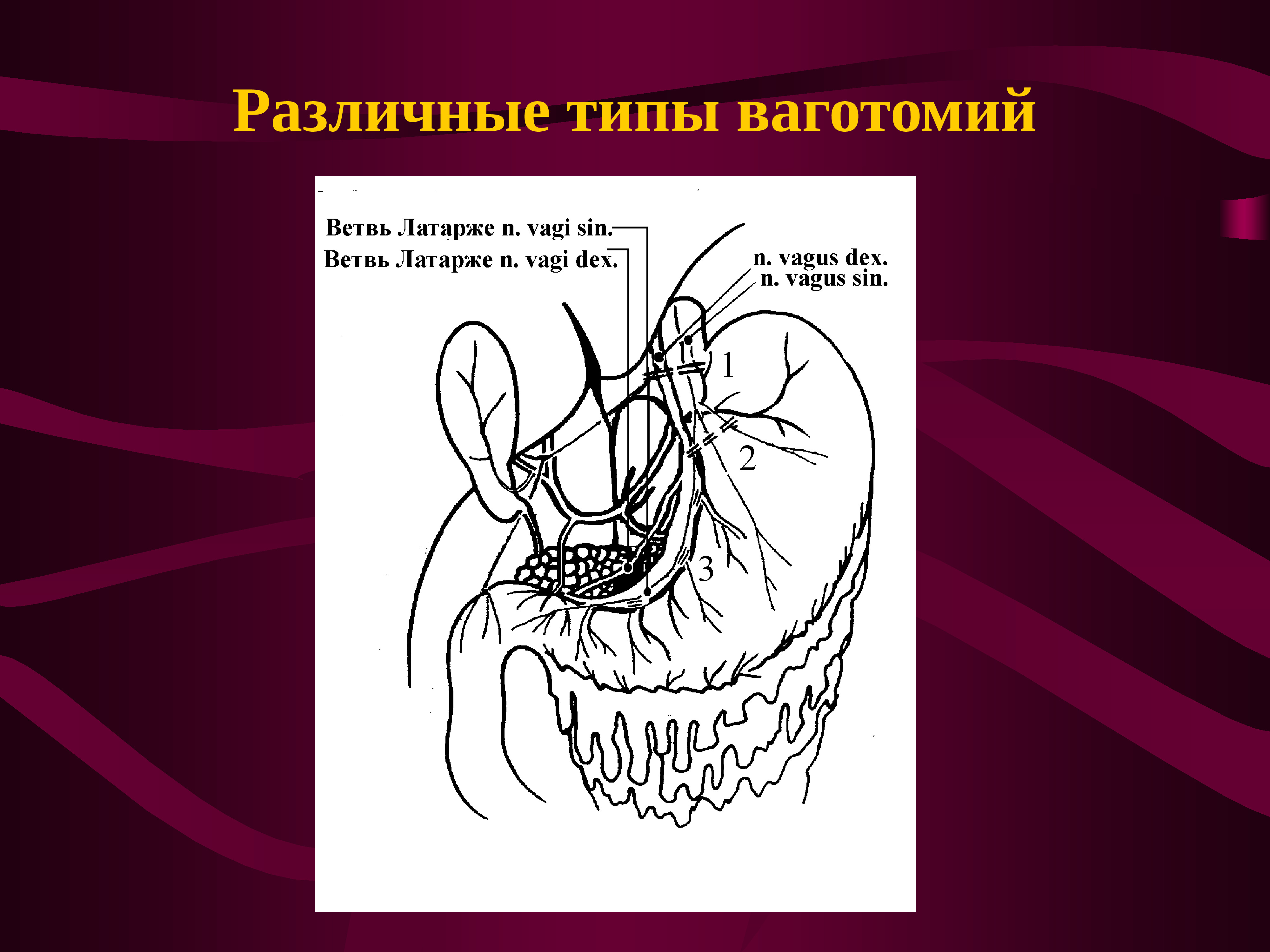 Болезни оперированного желудка презентация