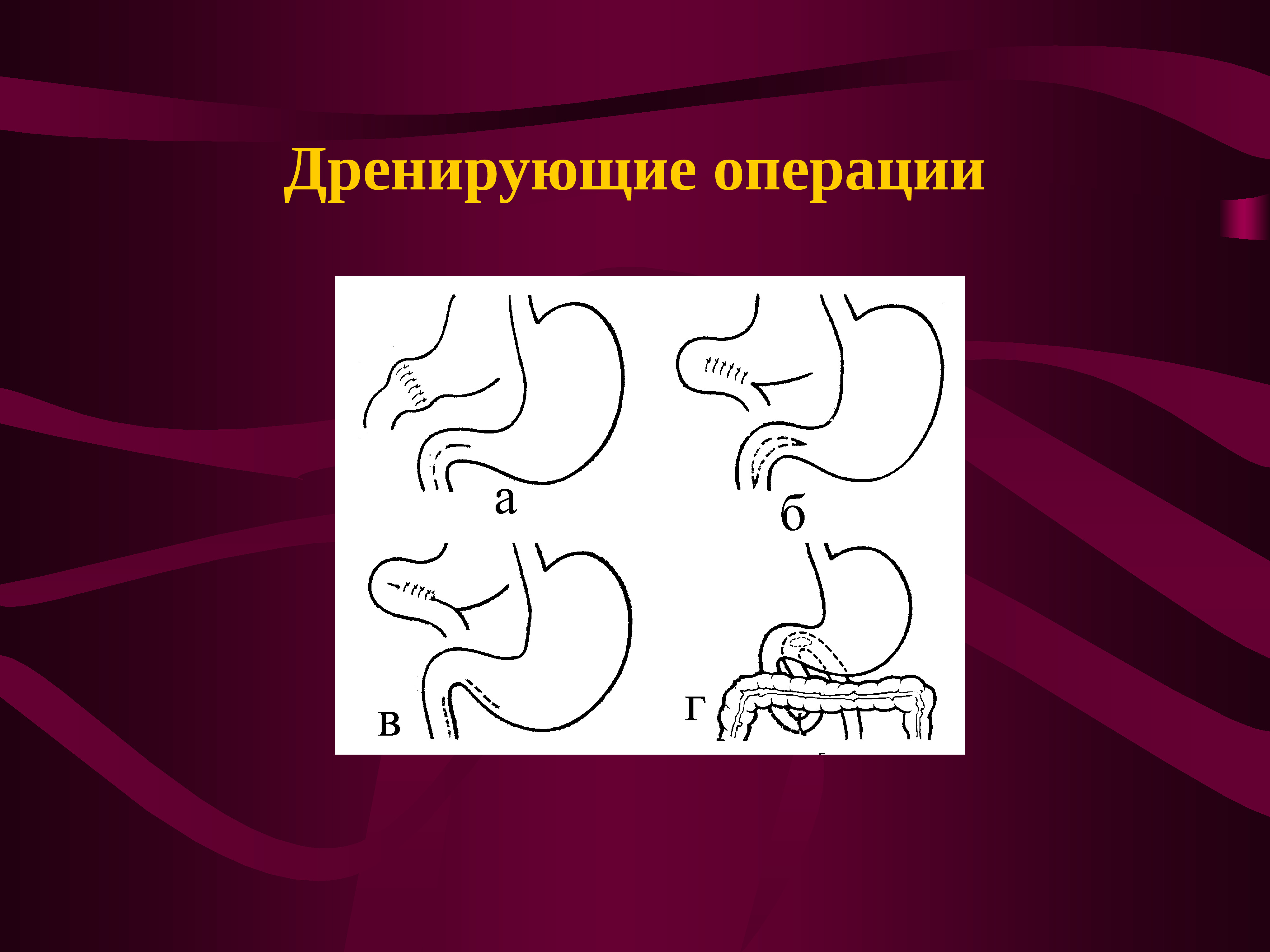 Презентация болезнь оперированного желудка