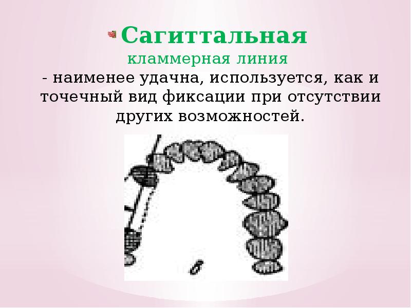 диагональное расположение кламмерной линии. феррул эффект ортопедическая стоматология. сагитальнвя класммерная линия. ферул ортопедическая стоматология. частичный съемный пластиночный протез состоит.