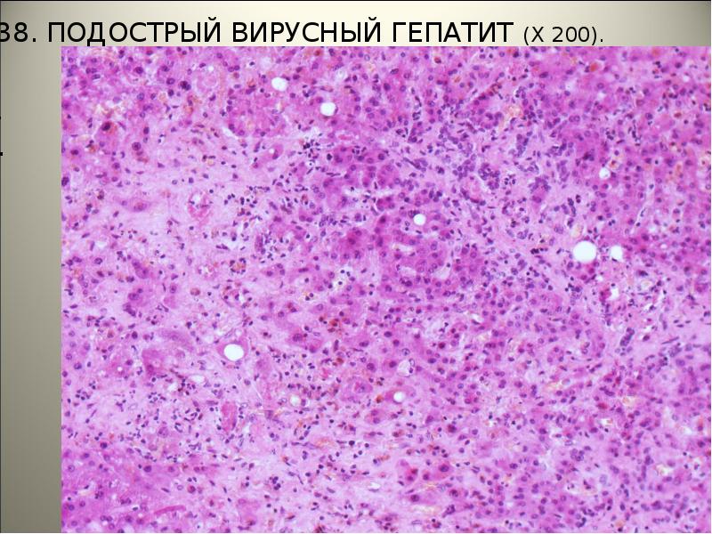 Кишечный гепатит. Подострый гепатит с массивным некрозом.