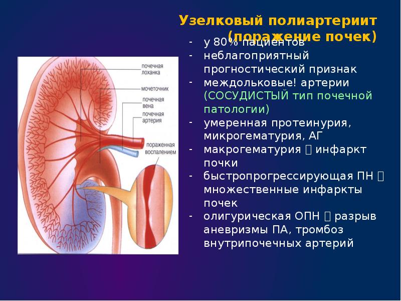 Узелковый полиартериит презентация