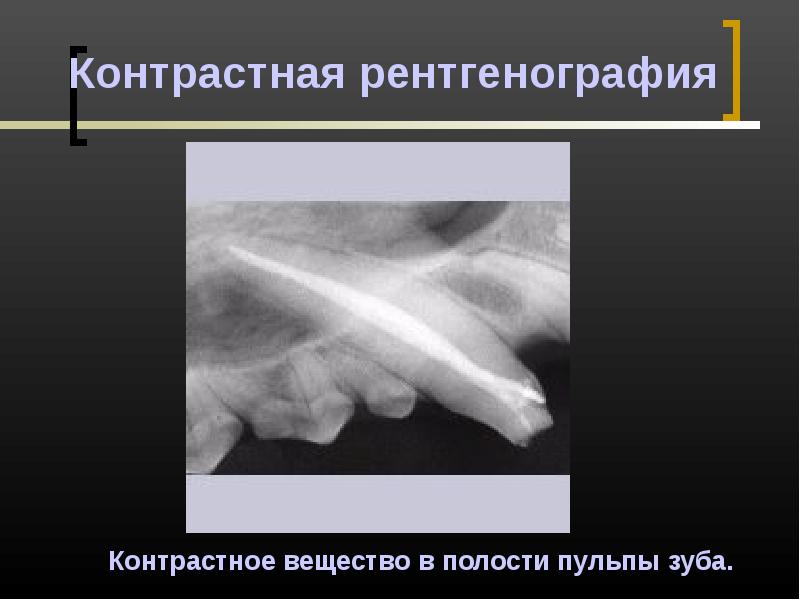 Рентгенография в эндодонтии презентация