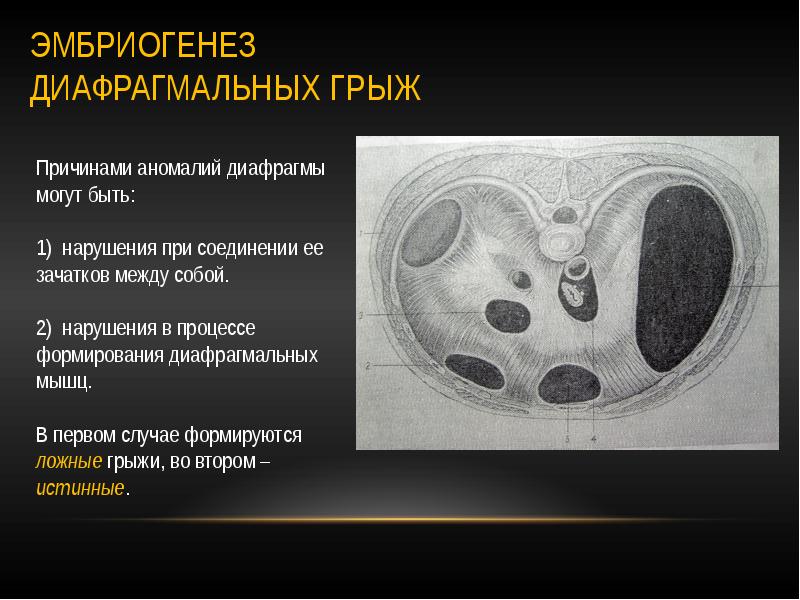 Диафрагмальные грыжи у детей презентация