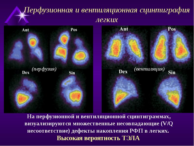 Сцинтиграмма является изображением