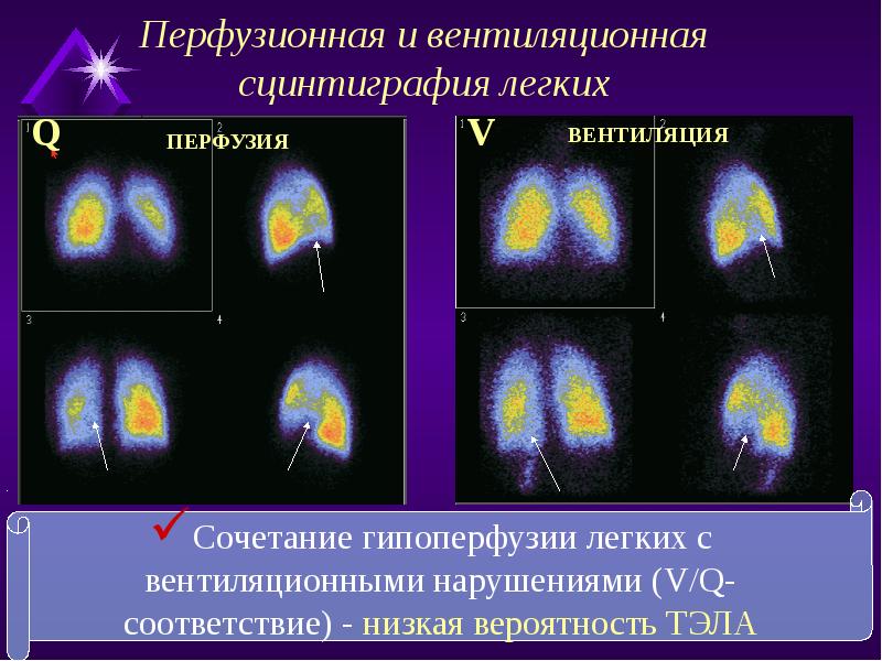 Радионуклидная диагностика. Вентиляционно-перфузионная сцинтиграфия. Вентиляционно-перфузионная сцинтиграфия легких. Сцинтиграфия вентиляционная эмфизема. Перфузионная и ингаляционная сцинтиграфия легких.