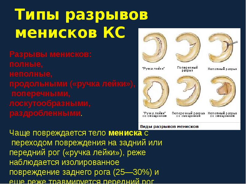 Застарелое повреждение менисков мкб. Комплексный разрыв медиального мениска по типу ручки лейки. • Разрыва заднего рога медиального мениска (по типу "ручки лейки". Горизонтальный разрыв заднего рога мениска.