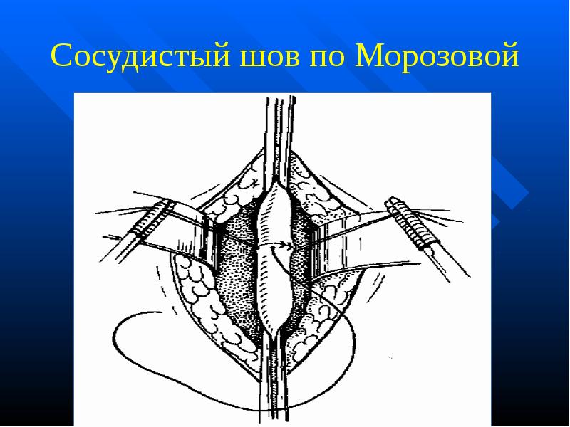 Основы сердечно-сосудистой хирургии. Сосудистый шов. Foto 17