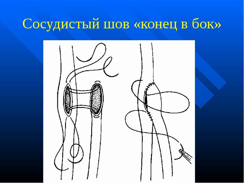 Лоскуты на микрососудистом анастомозе применяемые в челюстно лицевой хирургии презентация