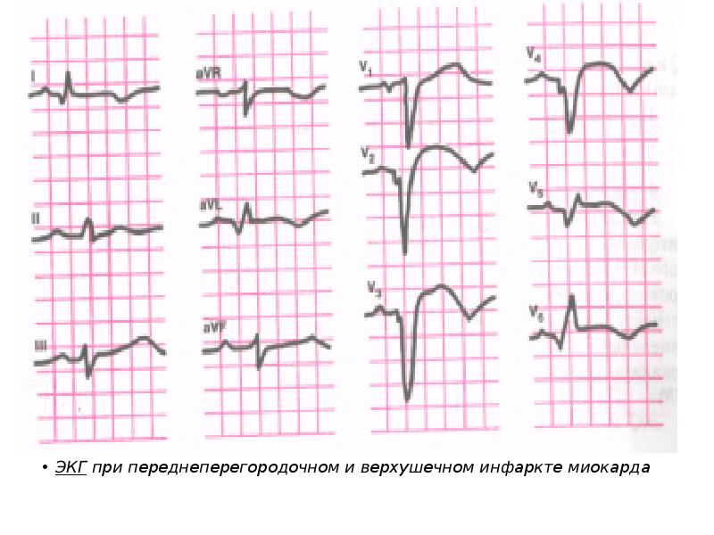 Переднебоковой инфаркт миокарда. ЭКГ при …