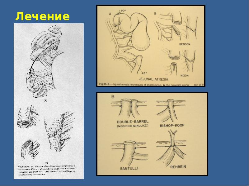 Врожденная кишечная непроходимость детская хирургия презентация