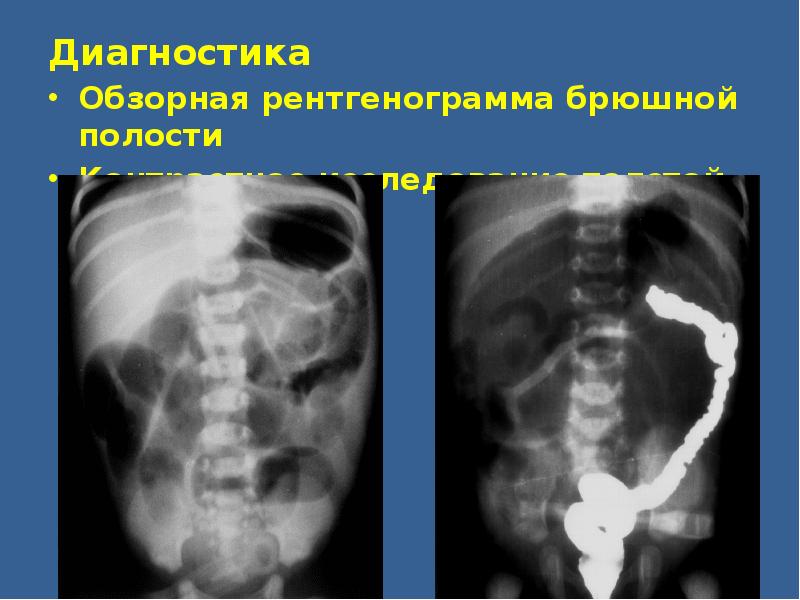 Обзорный рентген брюшной полости. Обзорная рентгенограмма брюшной полости. Обзорное исследование брюшной полости. Врожденная непроходимость желудочно-кишечного тракта.