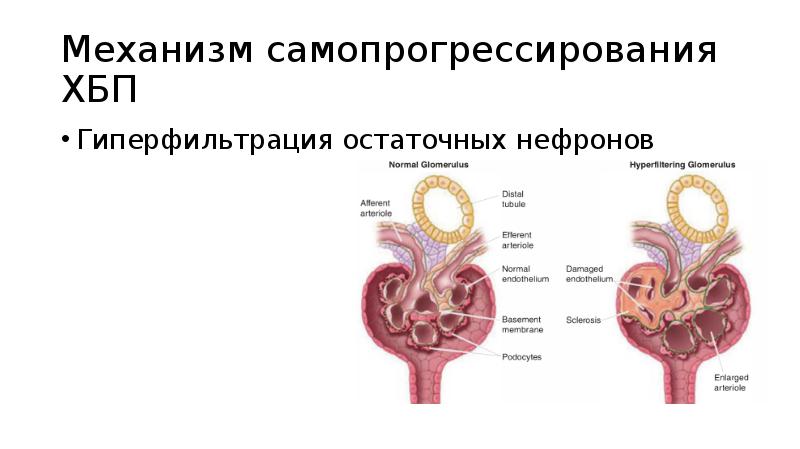 Патогенез хбп схема