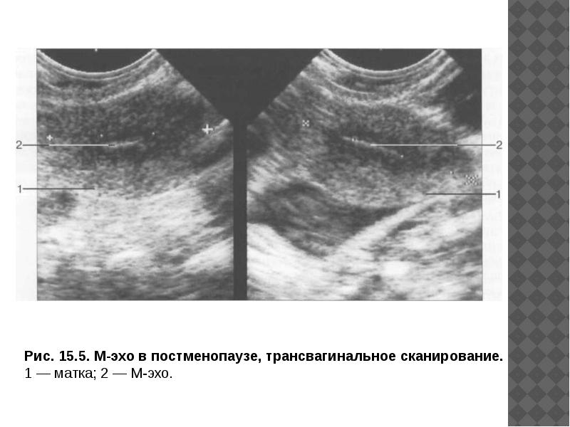 Постменопауза эндометрий норма