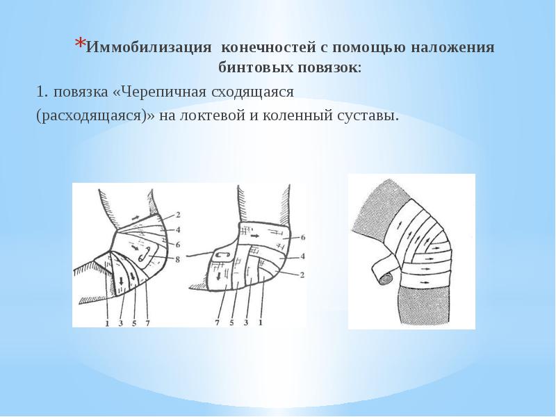 Десмургия иммобилизация. Повязка черепашья на локоть расходящаяся и сходящаяся. Черепашья сходящаяся на локтевой сустав повязка. Сходящаяся черепашья повязка на локтевой сустав алгоритм. Черепашья бинтовая повязка.