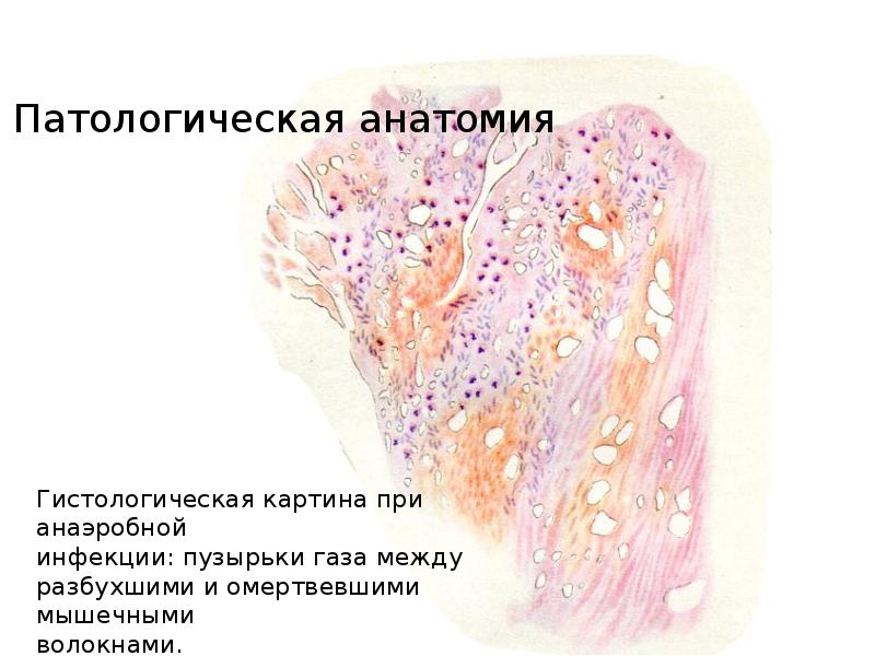 Патологическая картина. Кишечная коли инфекция патологическая анатомия. Анаэробная инфекция презентация. Воспаления при котором выделение пузырьков газа. Анаэробные инфекции в проктологии.