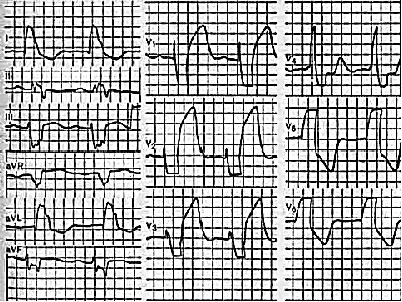Экг полное. Инфаркт миокарда на ЭКГ при ПБЛНПГ. Блокада левой ножки пучка Гиса и инфаркт миокарда на ЭКГ. Инфаркт при блокаде левой ножки пучка Гиса. Блокада левой ножки пучка Гиса Нижний инфаркт миокарда.