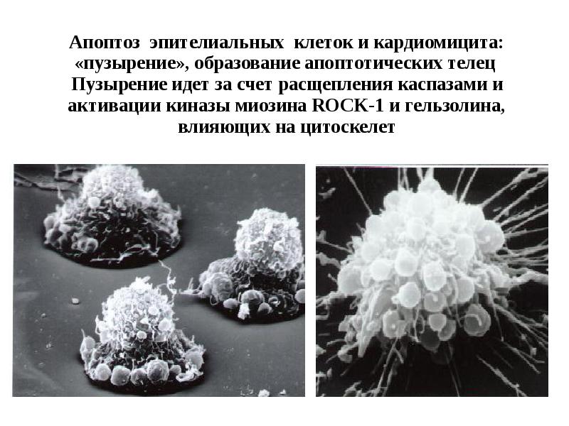 Апоптоз эпителиальных клеток и кардиомицита: «пузырение», образование апоптотических телец  Пузырение
