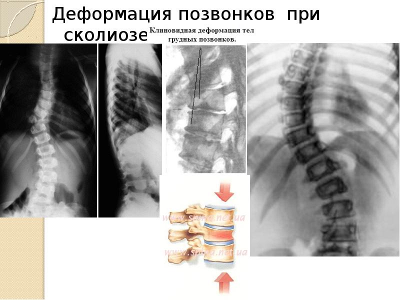 Врожденные деформации позвоночника презентация