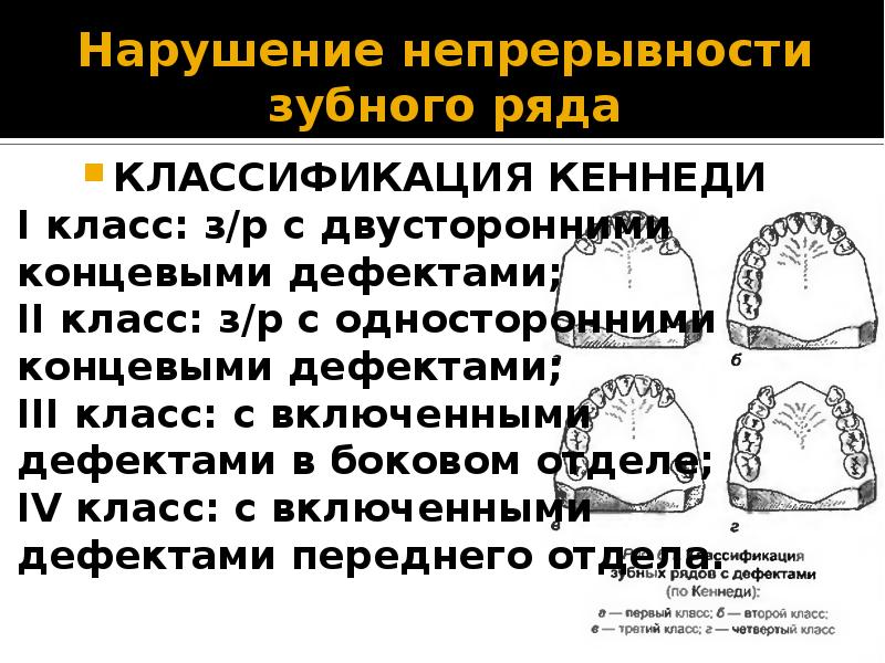 Дефекты зубных рядов. Классификация зубных рядов по Кеннеди и Гаврилову. Классификация дефектов зубных рядов по Кеннеди. Подклассы дефектов зубных рядов по Кеннеди. Классификация потери зубов по Кеннеди.