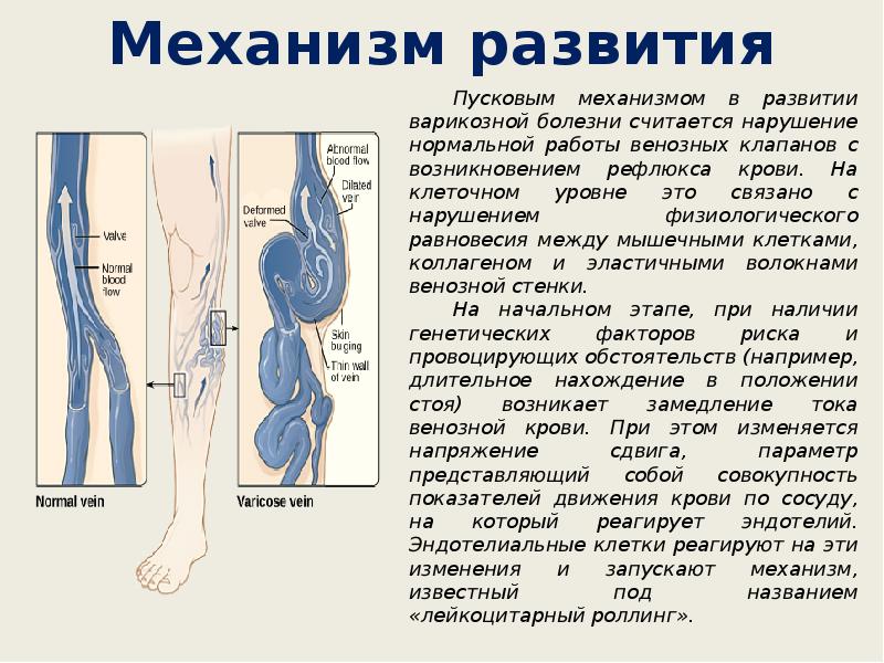 Диаметр вены. Варикозная болезнь вен нижних конечностей клиника. Анатомия варикозного расширения вен. Варикозное расширение вен презентация. Варикозное расширение вен нижних конечностей выводы.