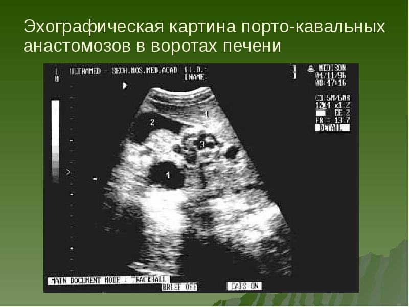 Эхографическая картина первичного рака печени характеризуется