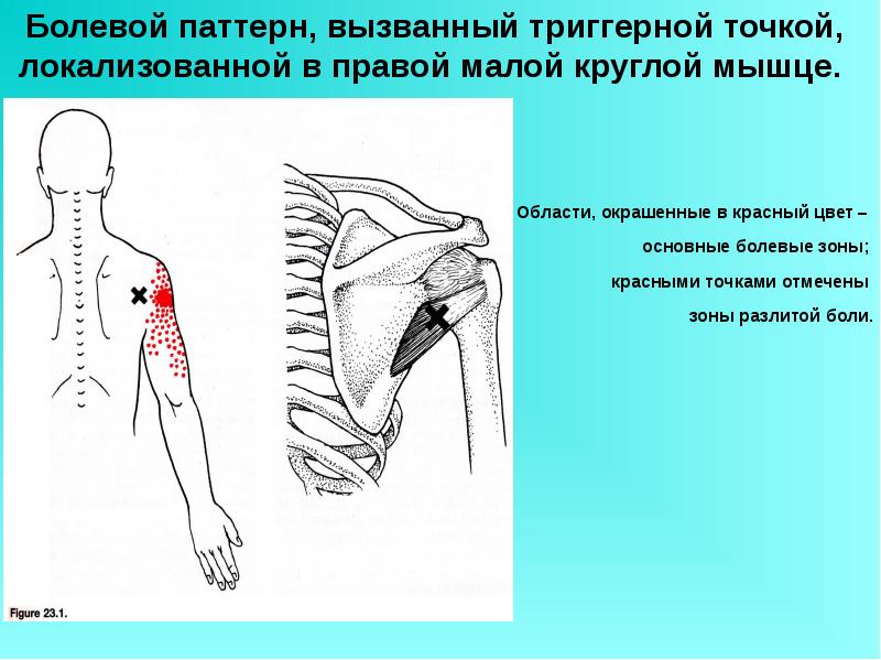 Точки мало. Триггерные точки малой круглой мышцы. Малая круглая мышца болит. Триггерные точки плечевого пояса. Болезненность малой круглой мышцы.