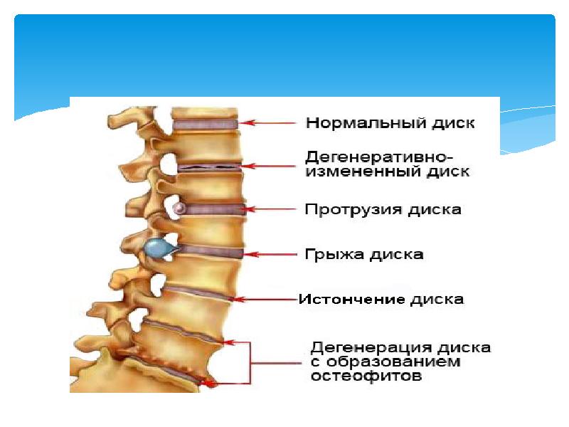 Краевые остеофиты тел позвонков что это такое фото