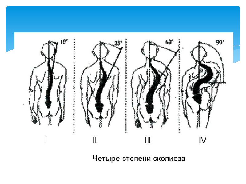 Степени сколиоза картинки