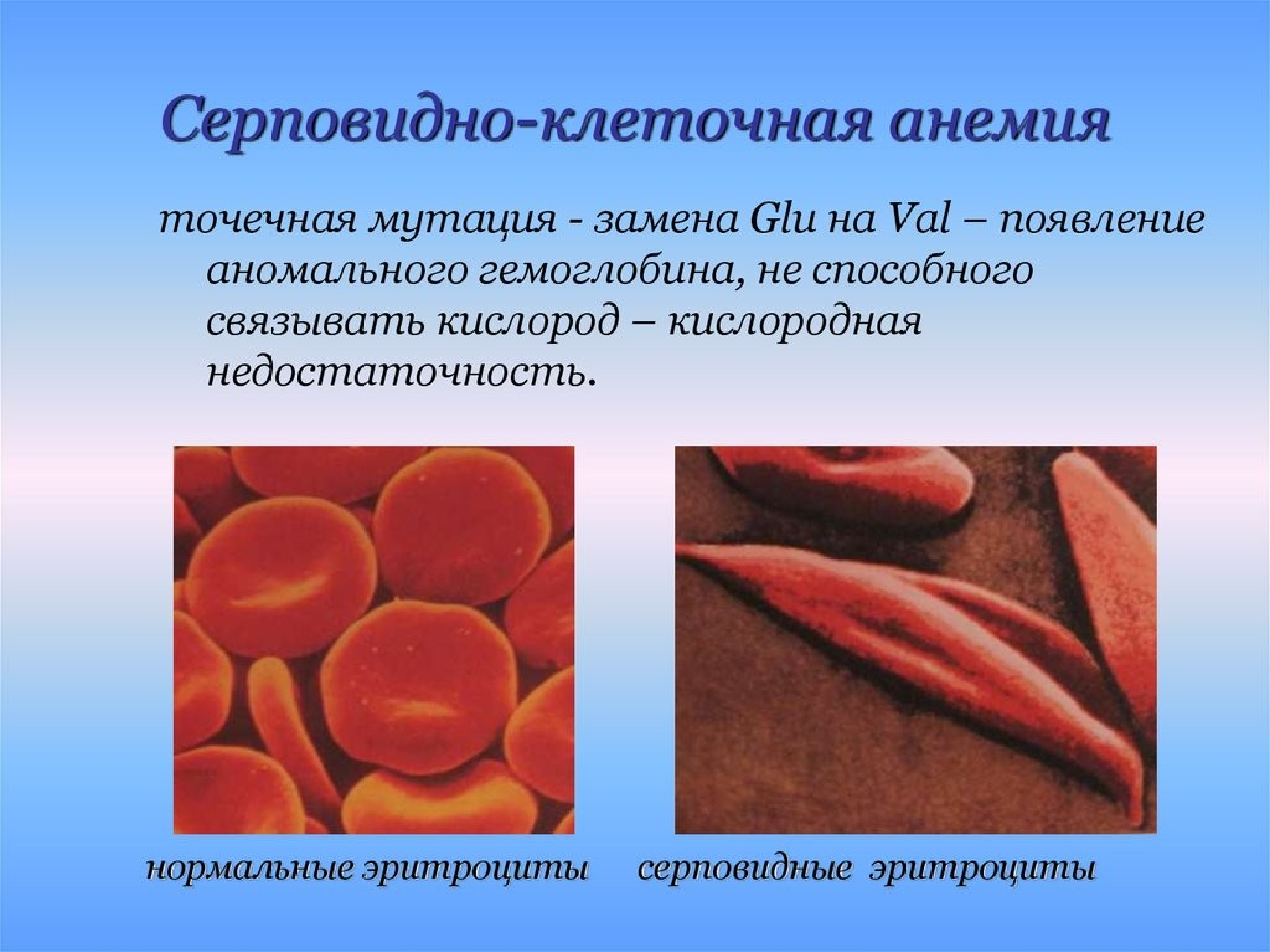 Эритроциты при серповидно клеточной анемии. Эритроциты при серповидноклеточной анемии. Серповидноклеточная анемия генная мутация. Серповидная анемия генное заболевание. Серповидная клеточная анемия гемоглобин.