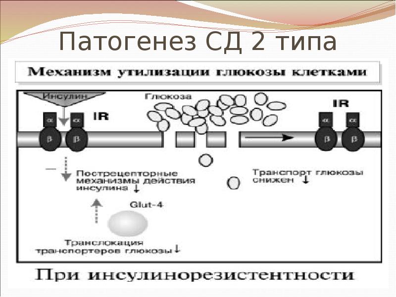 Патогенез сахарного диабета 2 типа схема