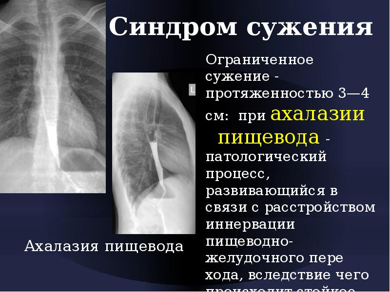 Лучевая диагностика пищевода презентация