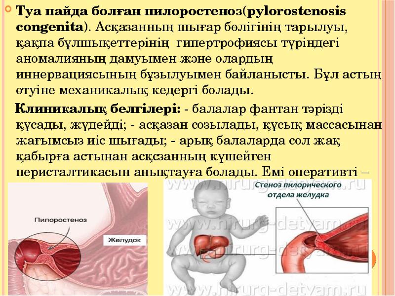 При пилоростенозе характерен стул