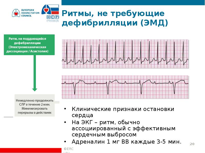 Признаки электромеханической диссоциации