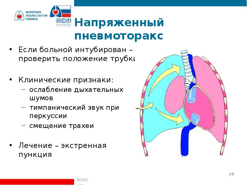 Спонтанный пневмоторакс карта смп