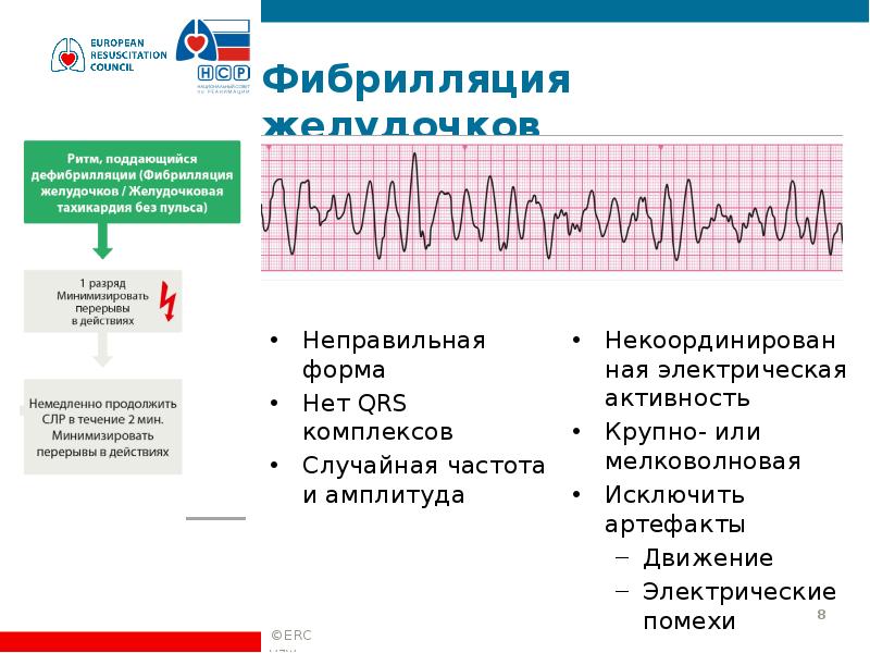 Отличие предсердий от желудочков. Крупноволновая фибрилляция желудочков СМП. Трепетание желудочков реанимация. Фибрилляция желудочков на ЭКГ. Асистолия и фибрилляция желудочков.
