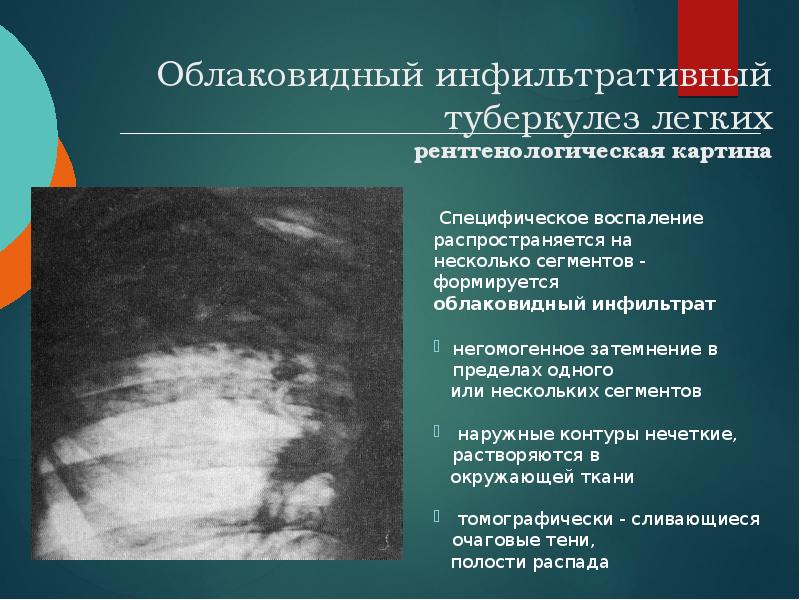 Облаковидный инфильтративный туберкулез легких рентгенологическая картина