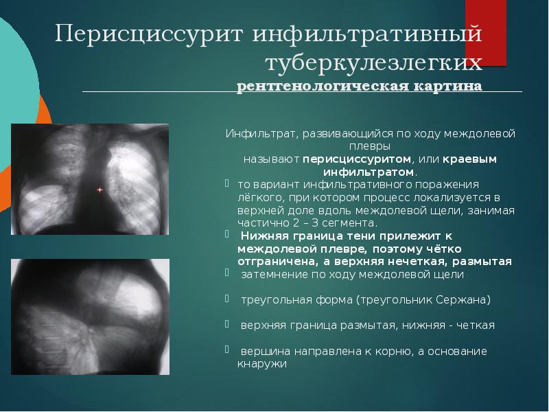 Перисциссурит инфильтративный туберкулезлегких рентгенологическая картина
