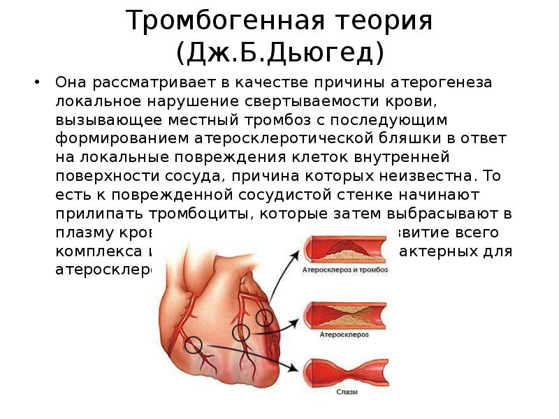 Теории развития атеросклероза. Тромбогенная теория атеросклероза Рокитанского. Теории патогенеза возникновения атеросклероза. Тромбогенная теория Дьюгеда. Тромбогенная теория атеросклероза патогенез.