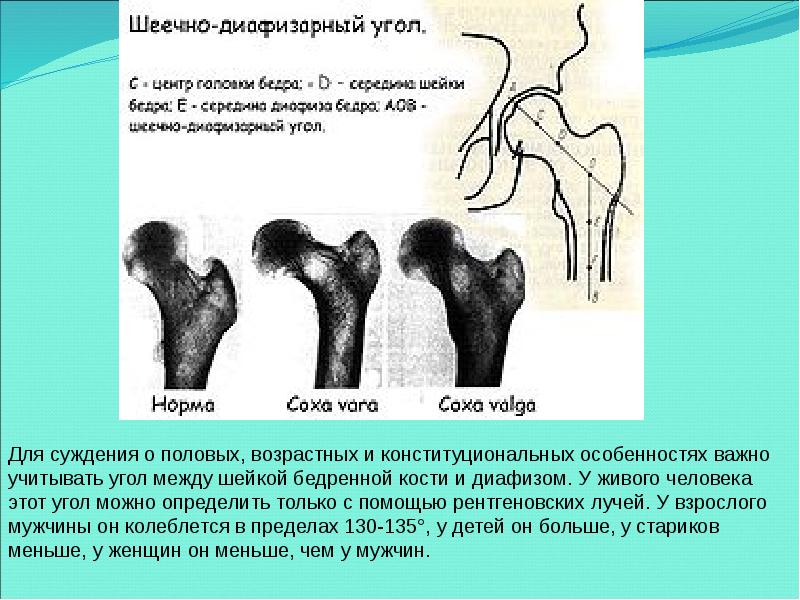 Шеечно диафизарный угол у детей норма таблица Улукбекова А.О. лекция " ЛФК при внутрисуставных и диафизарных переломах бедра