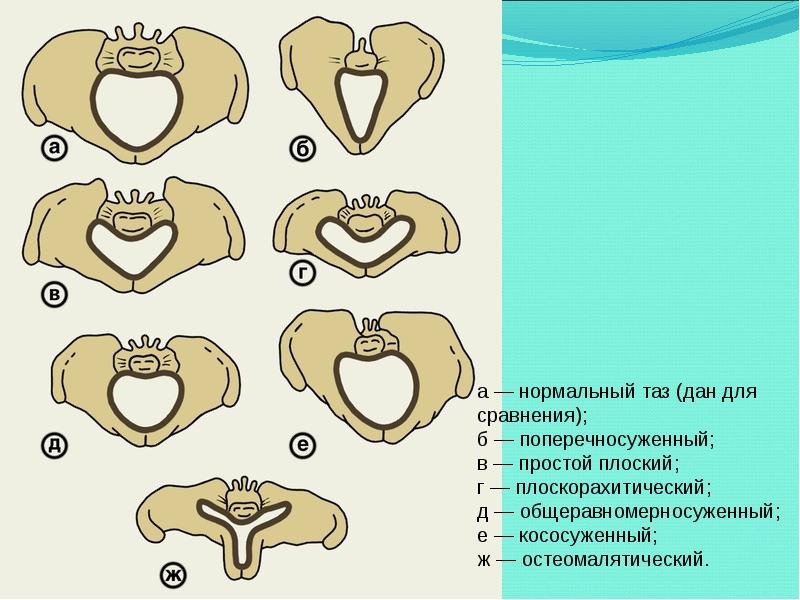 Какой таз лучше. Формы сужения таза Акушерство. Анатомически узкий таз формы. Формы узкого таза в акушерстве.
