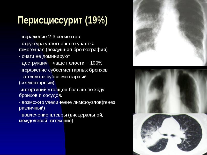 Лучевая диагностика органов дыхания презентация