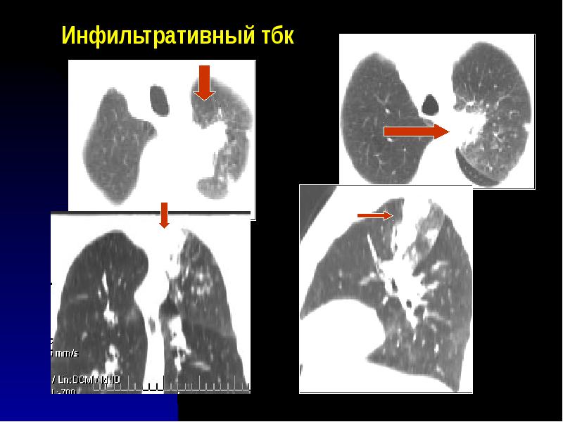 Лучевая диагностика туберкулеза презентация