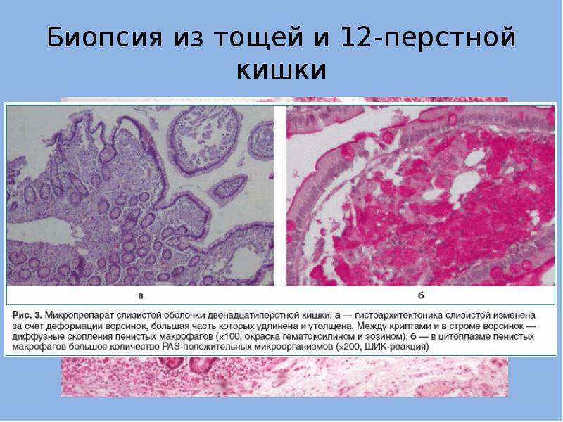 Болезнь уиппла презентация