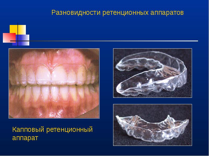 Ретенционные аппараты презентация