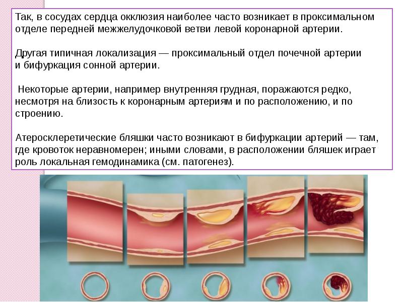 Презентация на тему атеросклероз