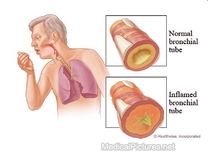 Хронический бронхит картинки для презентации