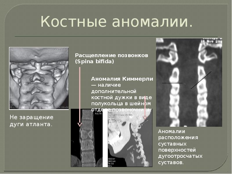 Презентация на тему расщепление позвоночника